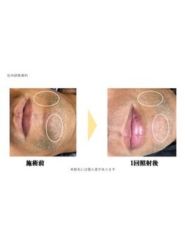 ダイアナ 出雲店(Daiana)/脱毛士による施術は技が違う