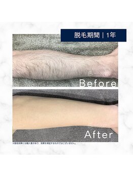 メンズクリア 四日市近鉄百貨店/【メンズクリア】お客様の施術例