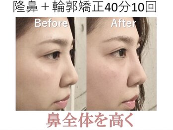 ラプリ 大阪心斎橋店(Raplit)/隆鼻＋輪郭矯正40分10回