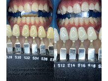トウキョースワーズ 渋谷店(TOKYO SWRS)/#ホワイトニング #渋谷 #池袋