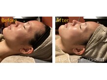 ロイヤリティ(ROYALTY)/毛穴/赤ら顔/肌のザラつき