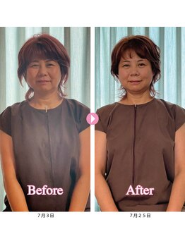 スピロソフィア/全身調整＋美容鍼