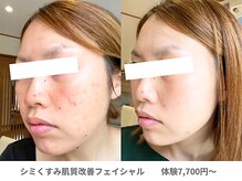 ピュアノア 垂水店/肌質改善フェイシャル　神戸垂水