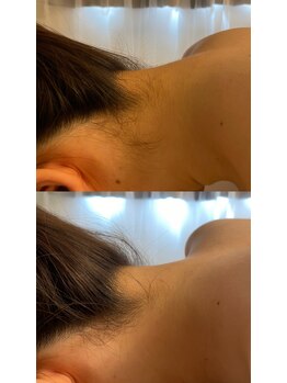 セルカ(CELCA)/うなじbefore after