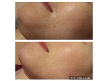 ベビースキン(baby skin)/毛穴の開き改善