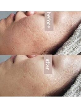 プシュケ(Psyche)/お客様の肌変化