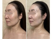 リフテグレース(LIFTE Grace)/骨格、肌質、肉質に合わせたケア