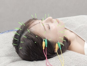 小顔美容鍼灸院HARIKA横浜店【美容鍼×小顔矯正×ブライダル】【4/1NEWOPEN（予定）】/ダウンタイムにオススメの美容鍼