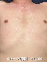 カナウ(KANAU)/【Sパーツ/脱毛】胸間