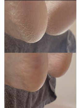 ネイルズ ビー 南昭和町本店(Nail's be)の写真/柔らかな踵へ！当店オリジナルの角質ケアはリピーター様続出の人気メニューです★