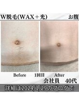 エスポワール(Espoir)/ダブル脱毛でその場でツルツル♪