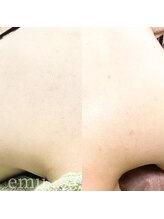 エミュ(emu)/背中wax＆光脱毛