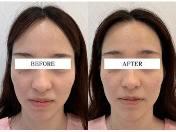 ハリランス(HARILANCE)/ほうれい線/左右差/たるみ