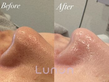 ルノン(Lunon)/毛穴洗浄ハイドロ