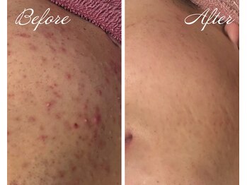 ローズドゥシャロン(Rose de CHALON)/ニキビ肌も徹底改善★