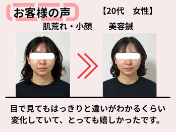 サロンスマイル/20代美容鍼ビフォーアフター