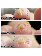 ミミカケルソラ(mimi×sora)/巻き爪補正♪