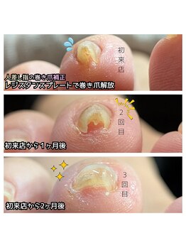 ミミカケルソラ(mimi×sora)/巻き爪補正♪