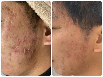 リュープリエ(Lieu plie)/ハーブピーリング