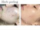 ムルア(MURUA)の写真/【Re:belleハーブピーリング】艶のある水光肌に★お肌をデトックスしながら肌質改善＊透明感のある素肌に！