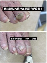 巻き爪じゅん 千葉駅前店/他で断られ続けた肥厚爪が改善