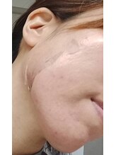 ラミーユ(La Miu)/【ハーブピーリング剥離中】