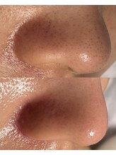 マリリン(MARILYN)/毛穴詰まり・開き毛穴改善