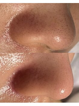 マリリン(MARILYN)/毛穴詰まり・開き毛穴改善