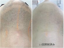 レイズ(RAISE)/メンズ人気！ヒゲ脱毛