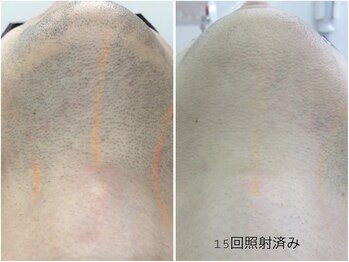 レイズ(RAISE)/メンズ人気！ヒゲ脱毛