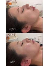 マホロバ(mahoroba)/美容鍼＋ララピール