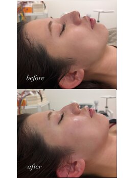 マホロバ(mahoroba)/美容鍼+ララピール