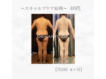 デマントイド(Demantoide&Co)/スキャルプで疲労もボディも激変