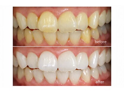 ココホワイトニング(coco whitening)の写真