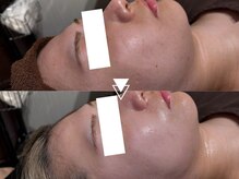 ルディラ医療提携エステ 立川店 毛穴/小顔/ニキビ・シミ・美白・シワ・たるみケアの雰囲気(【韓国肌管理】白玉フェイシャルで美白/ニキビケア/くすみ改善!)