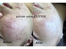 グリッター(GLITTER)/お肌改善トリートメント