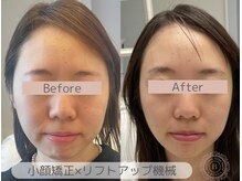 ベアール(beal)/小顔矯正×リフトアップ機械3回