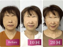 【たるみの改善】50代女性×加齢による、たるみや顔の大きさを改善、鏡に映った自分に自信が持てるように♪