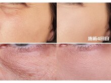 ナチュレアンドメディカ(Nature&Medica)/小じわ専門ケア（プラズマ）