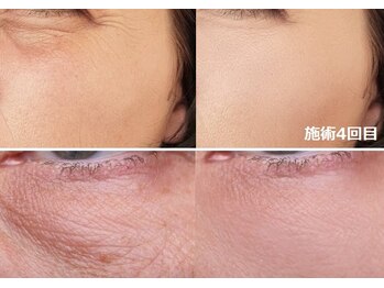 ナチュレアンドメディカ(Nature&Medica)/小じわ専門ケア(プラズマ)