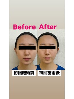 ゆうはり鍼灸整骨院 恵比寿/お客様Before　After