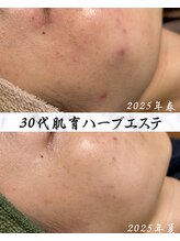 サロン ド エン(Salon de. en)/長年のニキビ◇ハーブピーリング