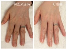 キレイテ 福岡天神店/50代/6回目【天神ハンドケア】