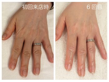 キレイテ 福岡天神店/50代/6回目【天神ハンドケア】