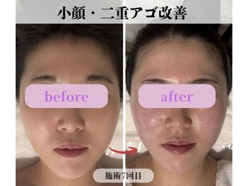 ミピマム 横浜駅前店/小顔・二重あご改善BeforeAfter