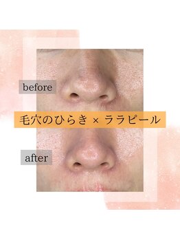 アーニストリィ(Earnestly)/ララピールで内側からお肌をケア