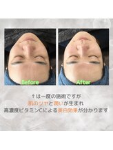 ブルービードロ(Blue beedro)/シフォンピーリングBefore/After