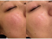 ハリランス(HARILANCE)/小顔/ゆがみ/中顔面短縮