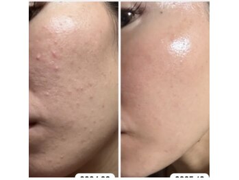 ヨノ(Yono)/ラミネーションピーリング☆