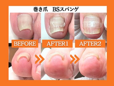 巻き爪ならドイツ最新技術のＢＳスパンゲで効果◎